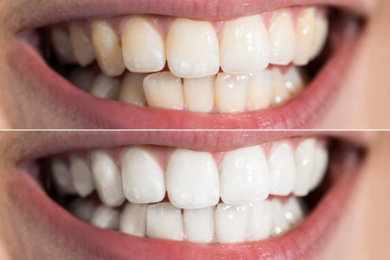 Zahn Bleaching bei Dr. Achim in Wien